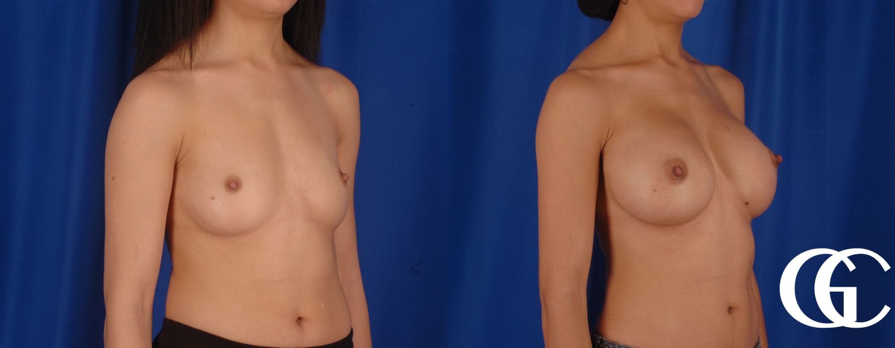 Breast Augmentation - Thumbnail 3