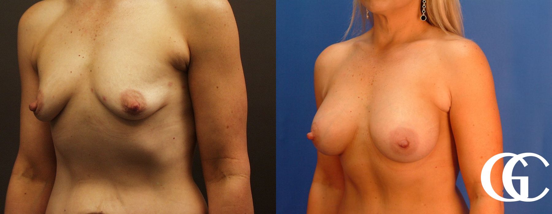 Breast Augmentation - Case 7107