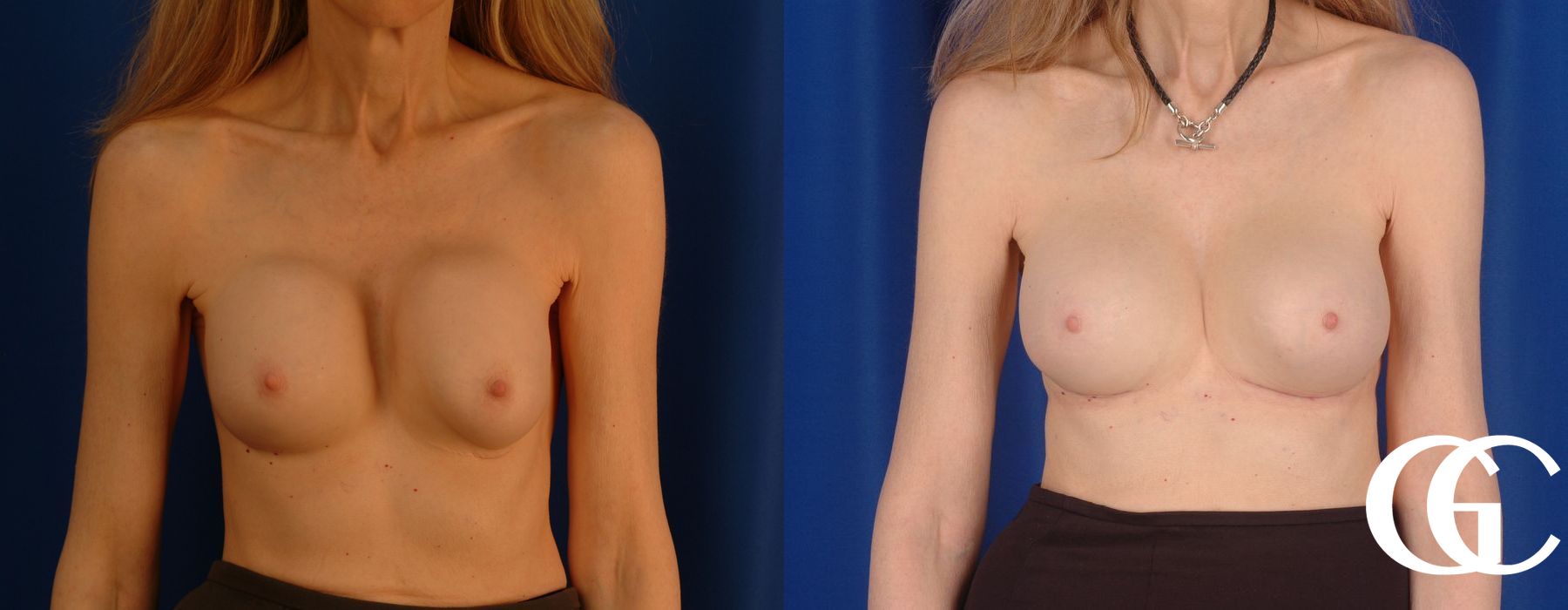 Breast Augmentation - Thumbnail 3
