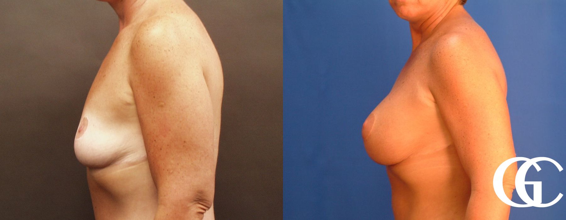 Breast Augmentation - Thumbnail 4