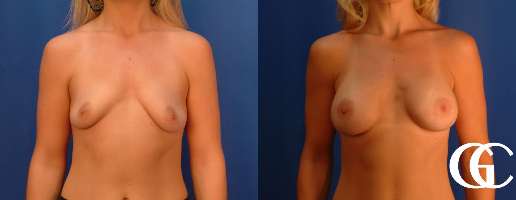 Breast Augmentation - Thumbnail 3