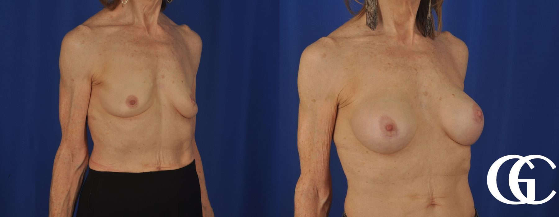 Breast Augmentation - Thumbnail 2