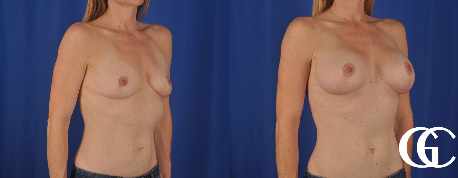 Breast Augmentation - Thumbnail 2
