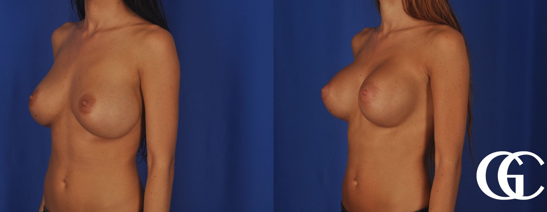 Breast Augmentation - Thumbnail 5