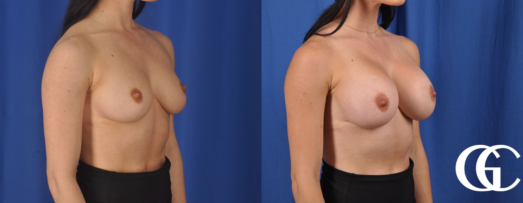 Breast Augmentation - Case 7181
