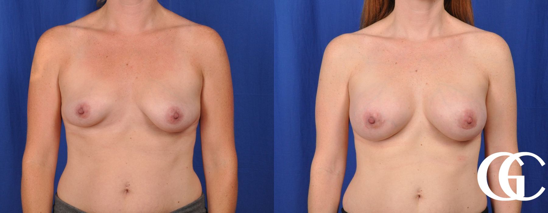Breast Augmentation - Thumbnail 2