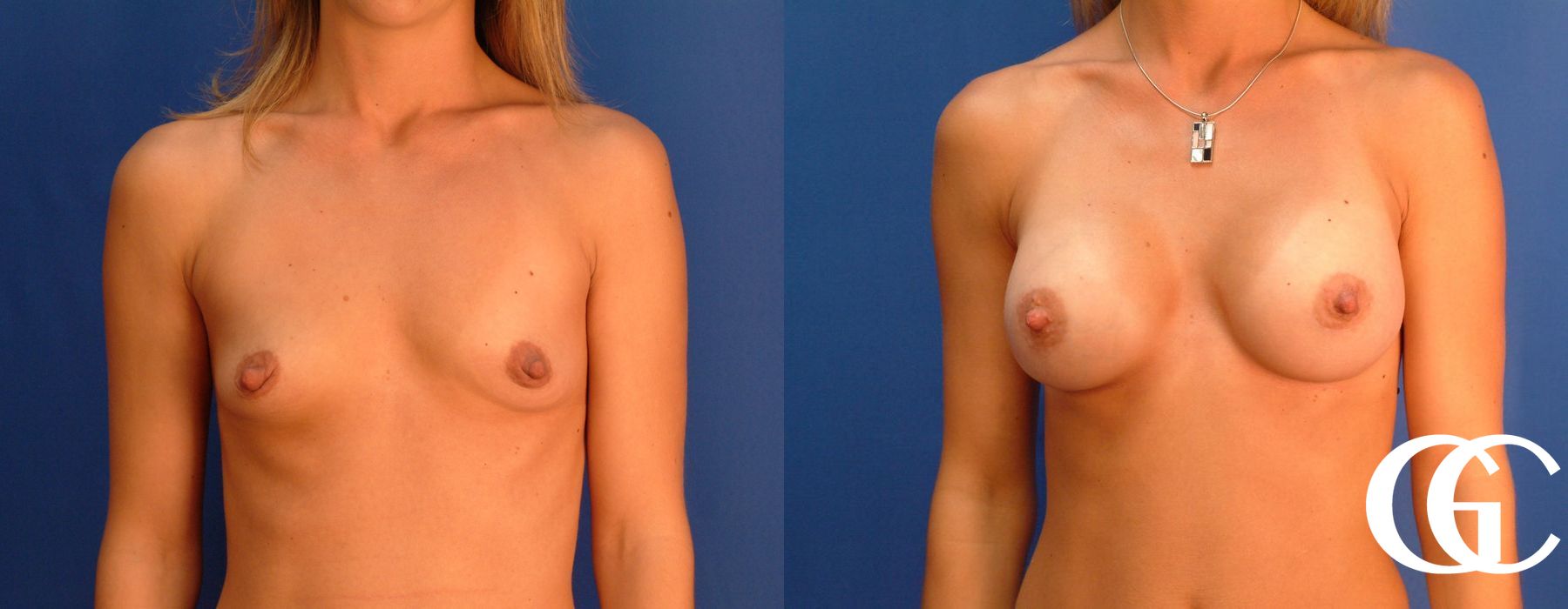 Breast Augmentation - Thumbnail 2