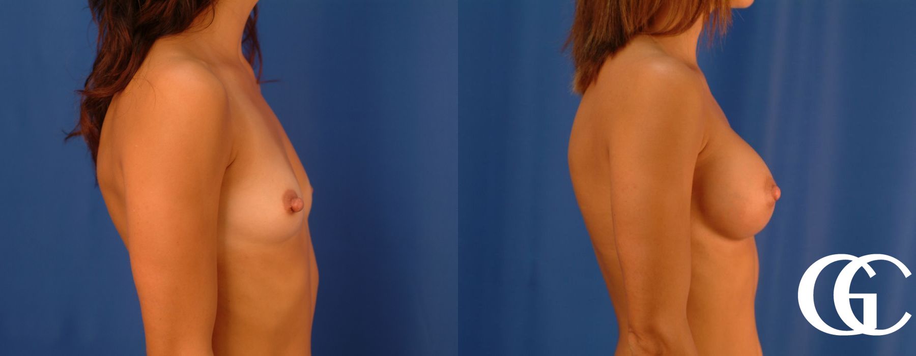 Breast Augmentation - Thumbnail 3