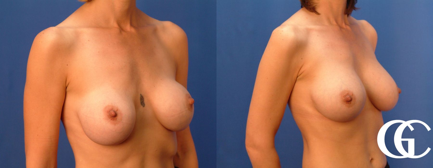 Breast Augmentation - Thumbnail 3