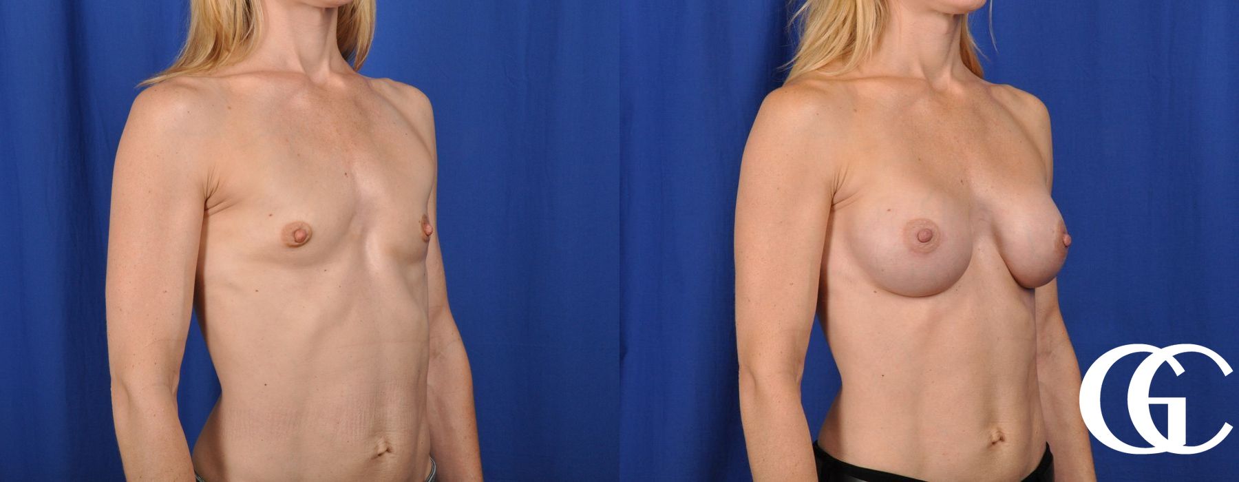 Breast Augmentation - Case 7037