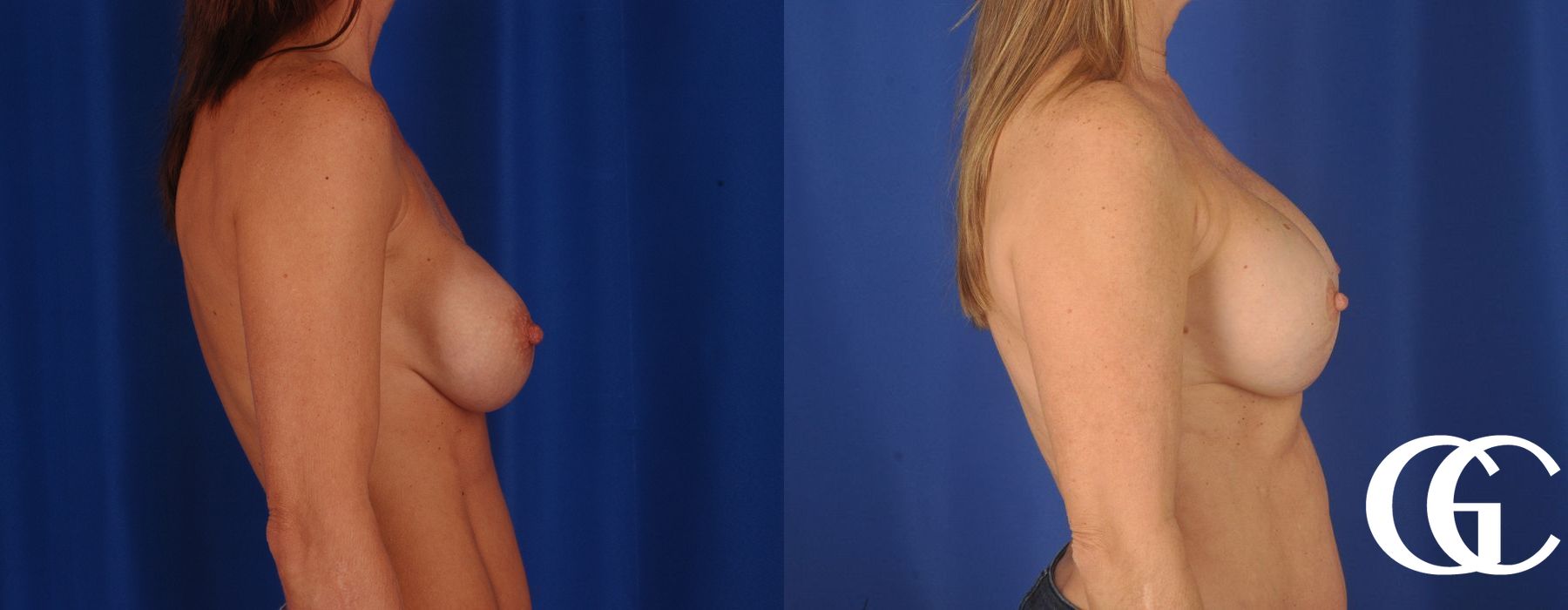 Breast Augmentation - Thumbnail 4