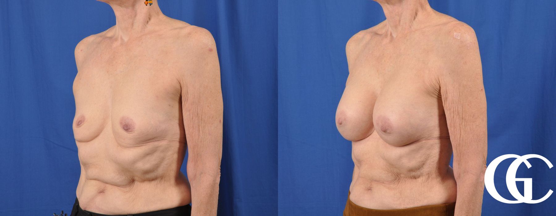 Breast Augmentation - Thumbnail 4