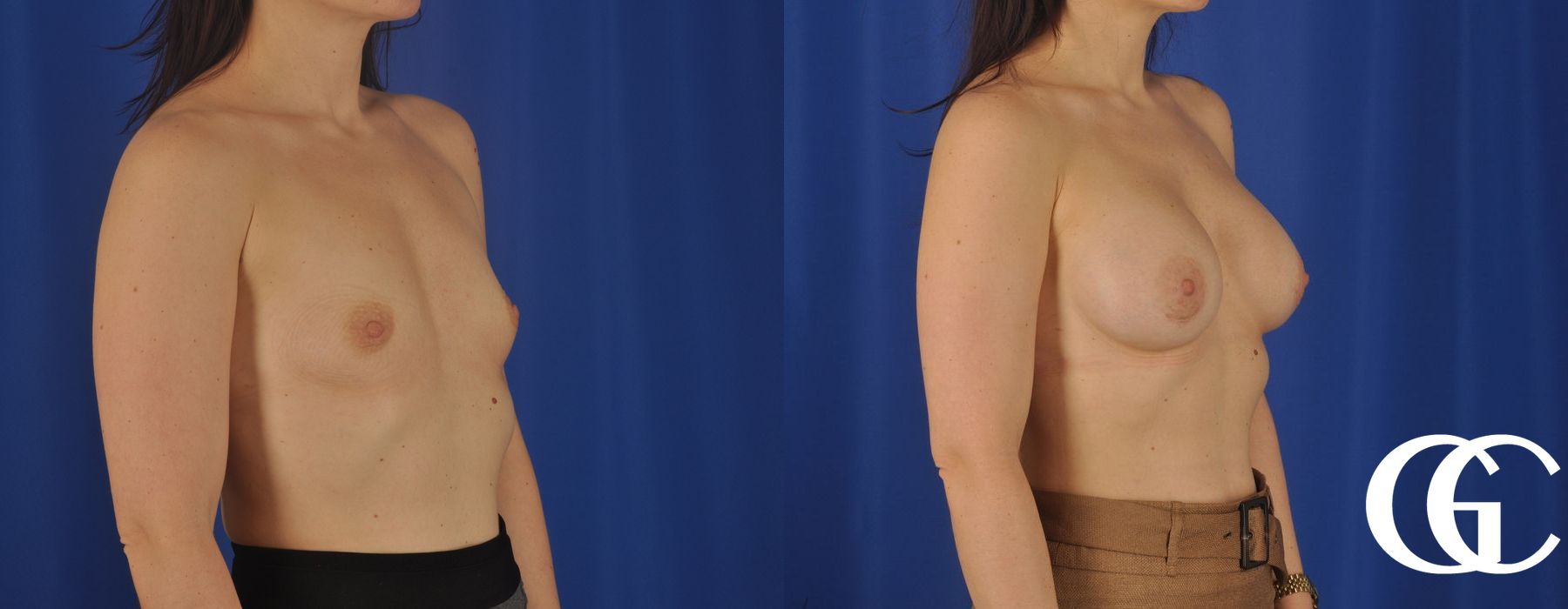 Breast Augmentation - Thumbnail 4