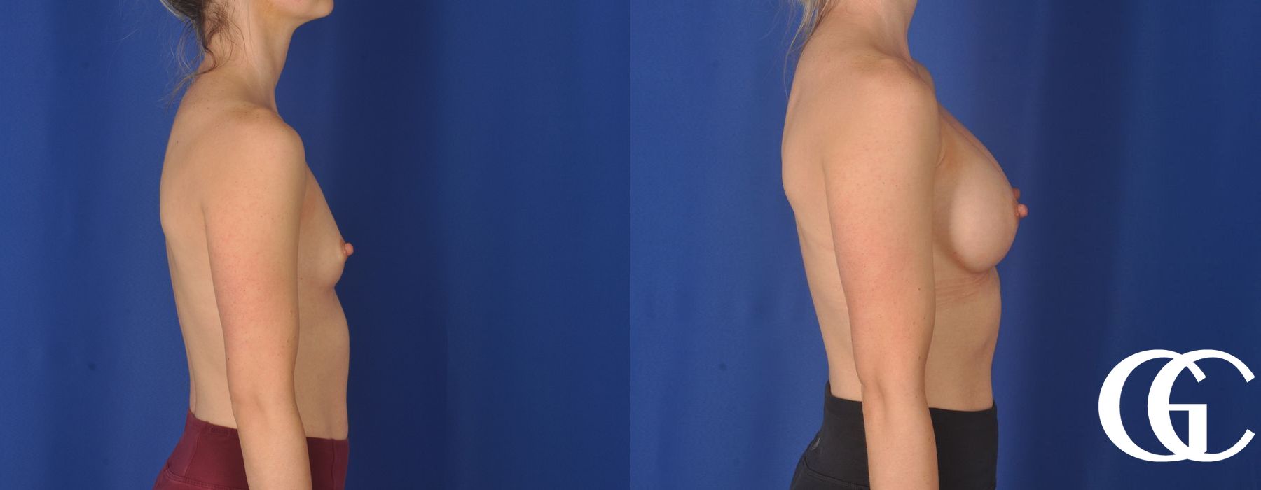 Breast Augmentation - Thumbnail 4