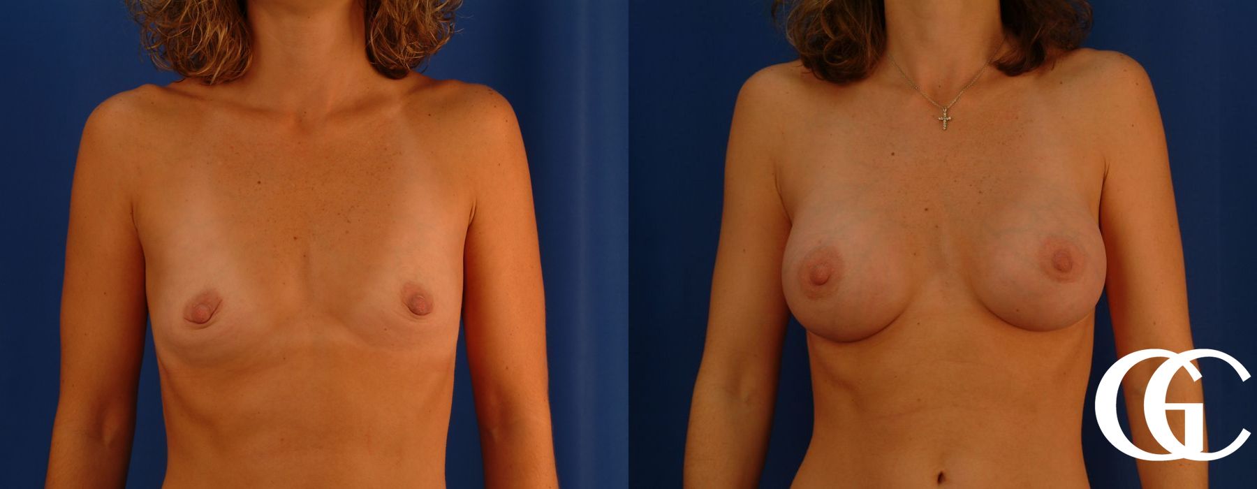 Breast Augmentation - Thumbnail 2