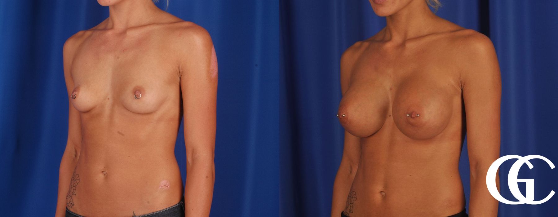 Breast Augmentation - Thumbnail 4