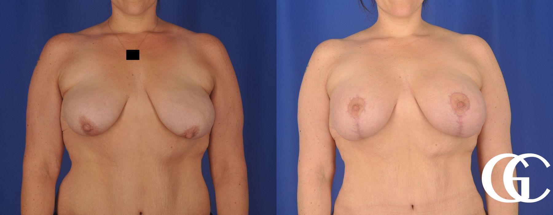 Breast Augmentation - Thumbnail 3
