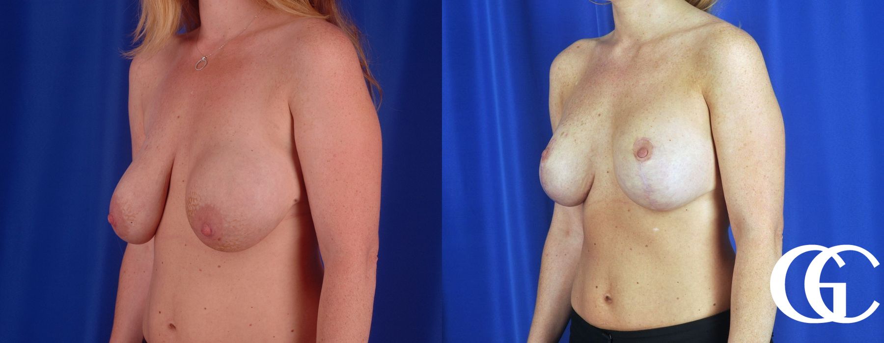 Breast Augmentation - Thumbnail 3