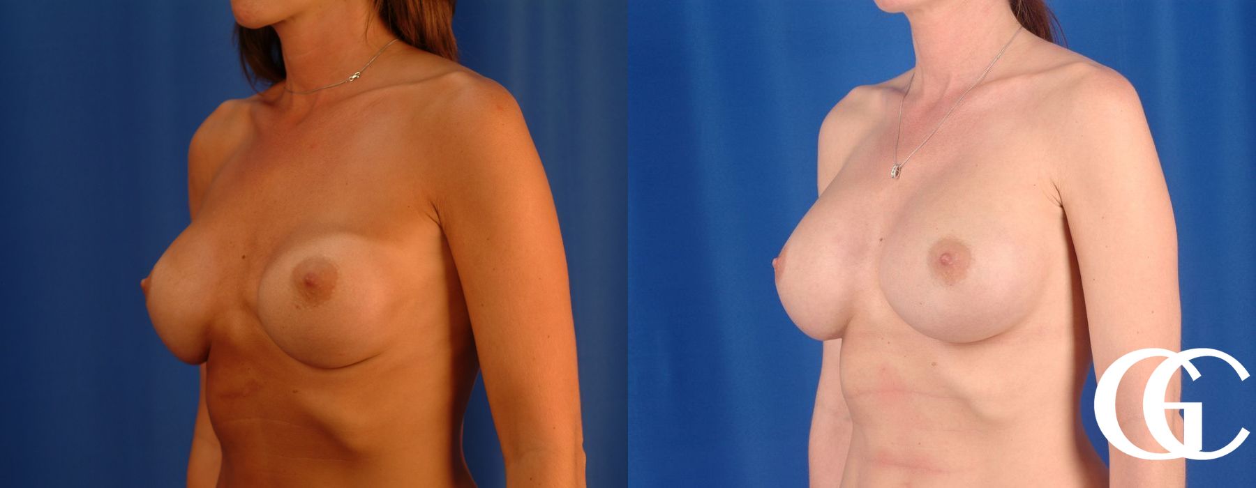 Breast Augmentation - Thumbnail 5