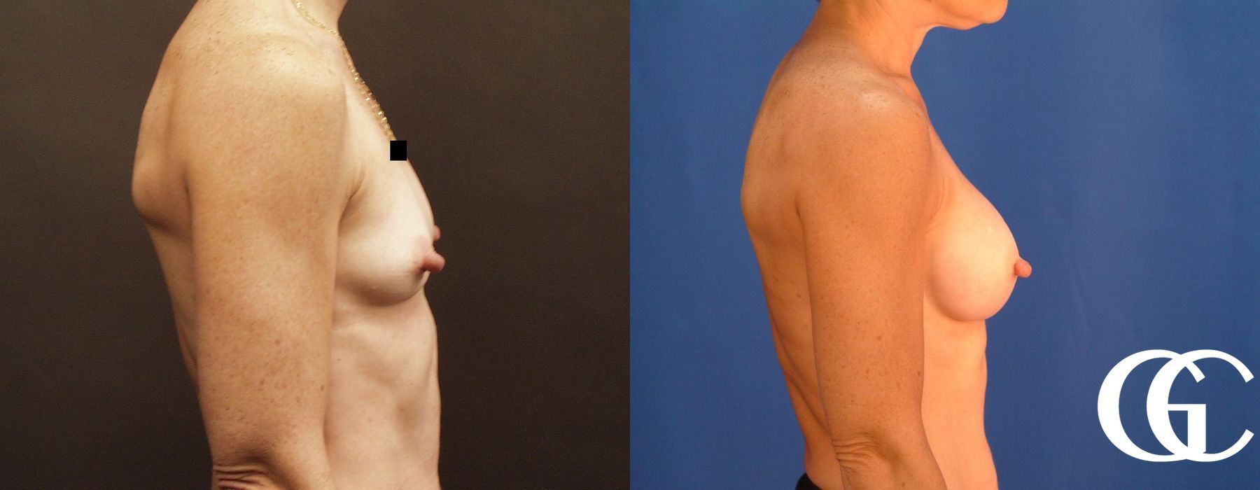 Breast Augmentation - Case 7110