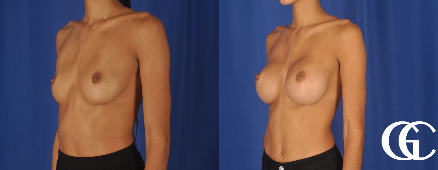 Breast Augmentation - Thumbnail 2