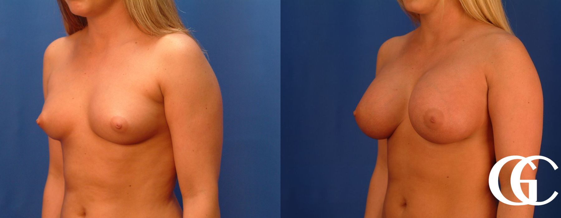 Breast Augmentation - Thumbnail 2