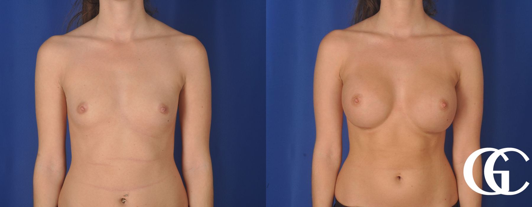 Breast Augmentation - Thumbnail 2