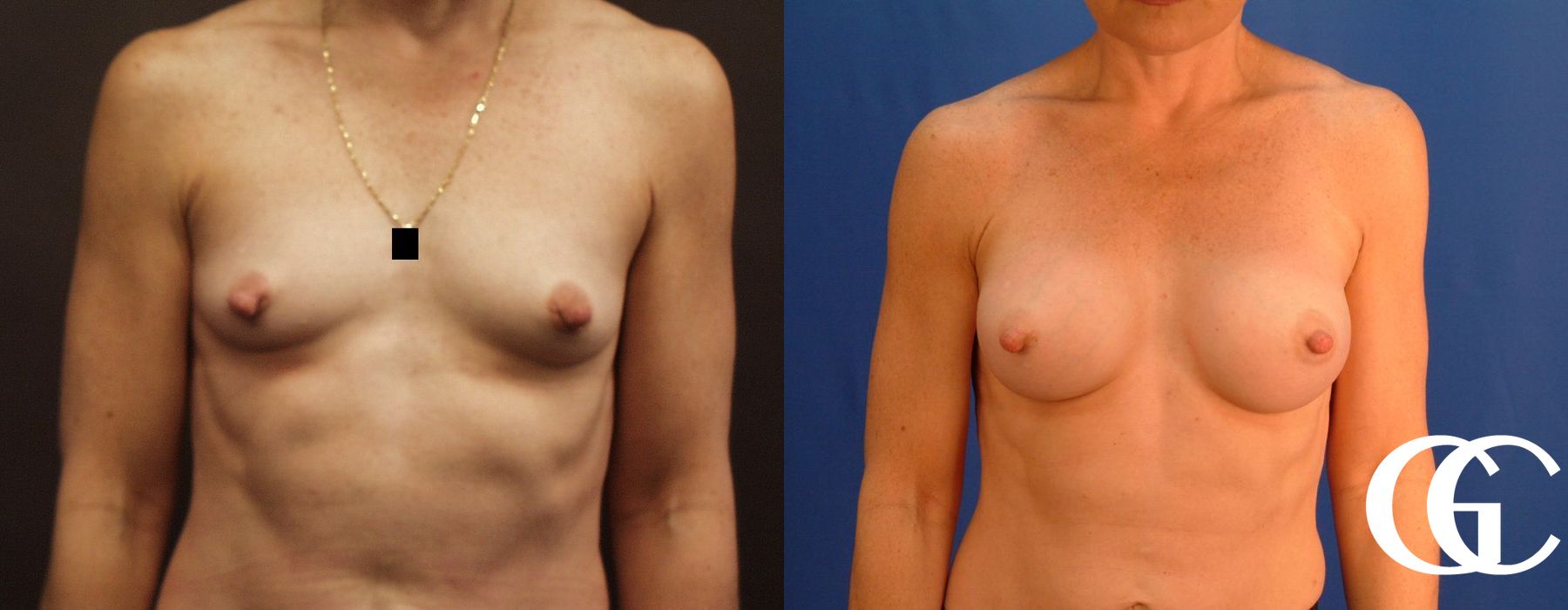 Breast Augmentation - Thumbnail 2