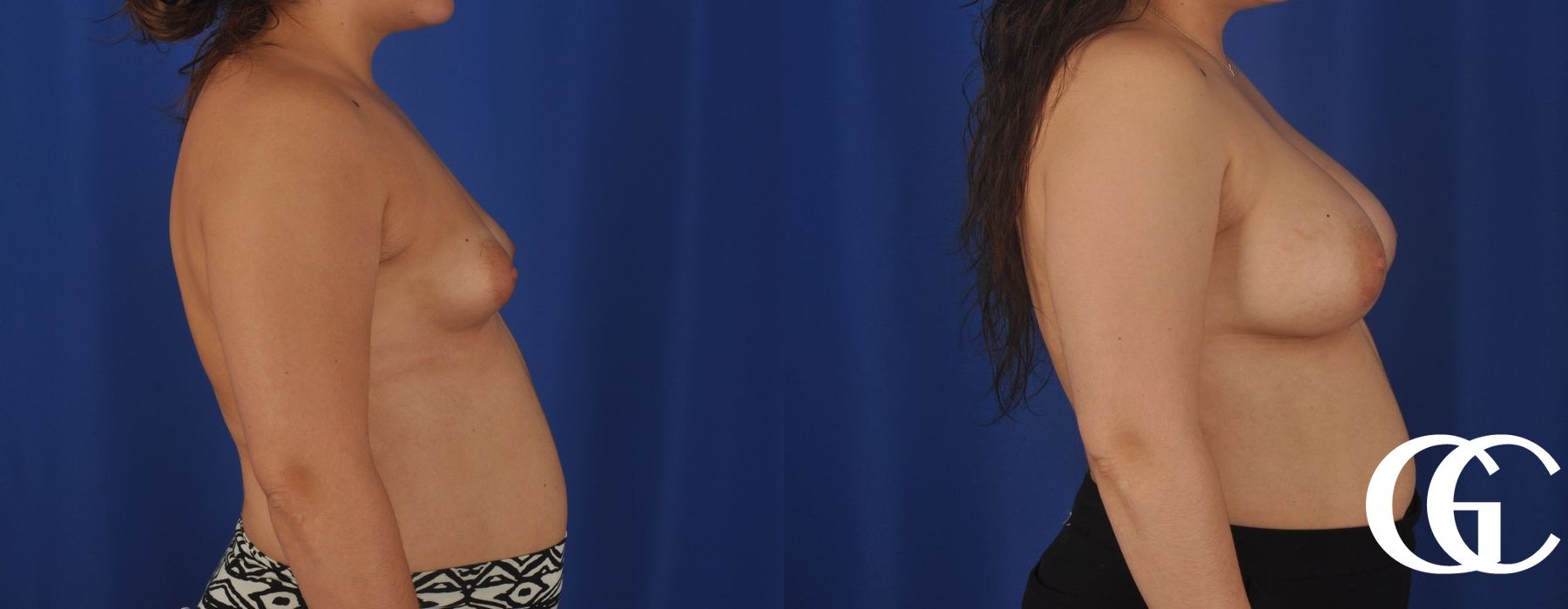 Breast Augmentation - Case 7133