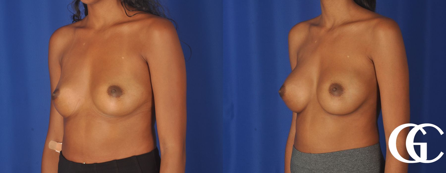 Breast Augmentation - Thumbnail 4