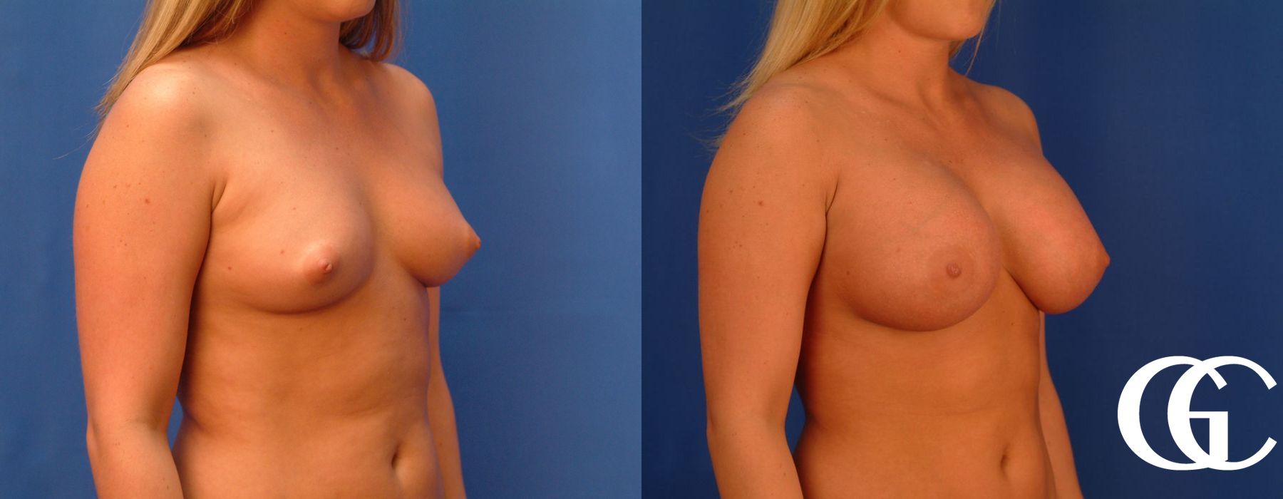 Breast Augmentation - Thumbnail 4