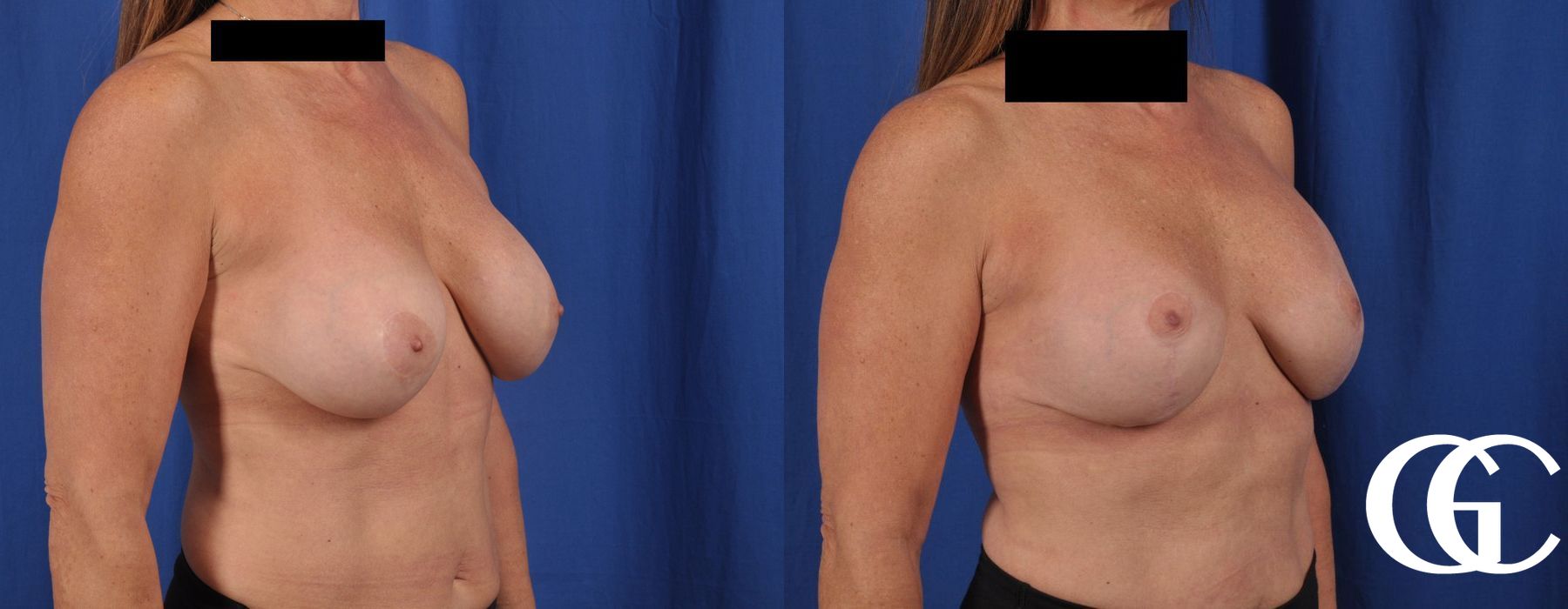 Breast Augmentation - Thumbnail 3