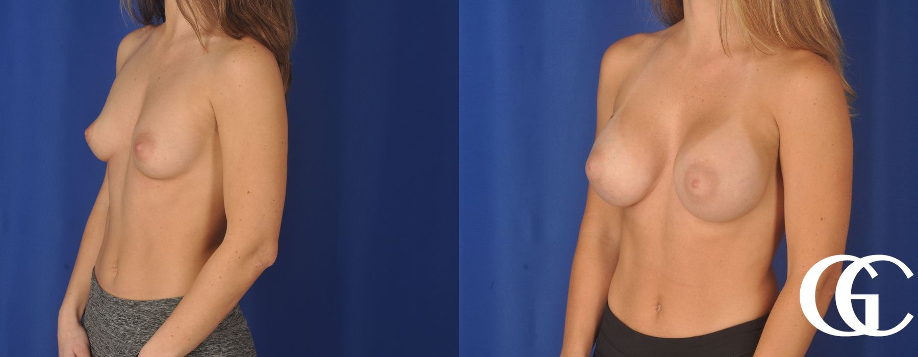 Breast Augmentation - Case 7175