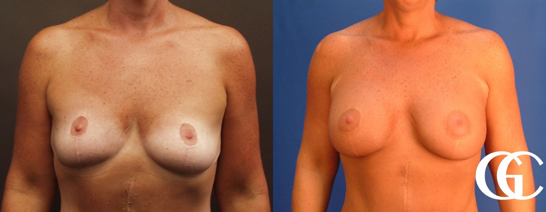 Breast Augmentation - Thumbnail 2