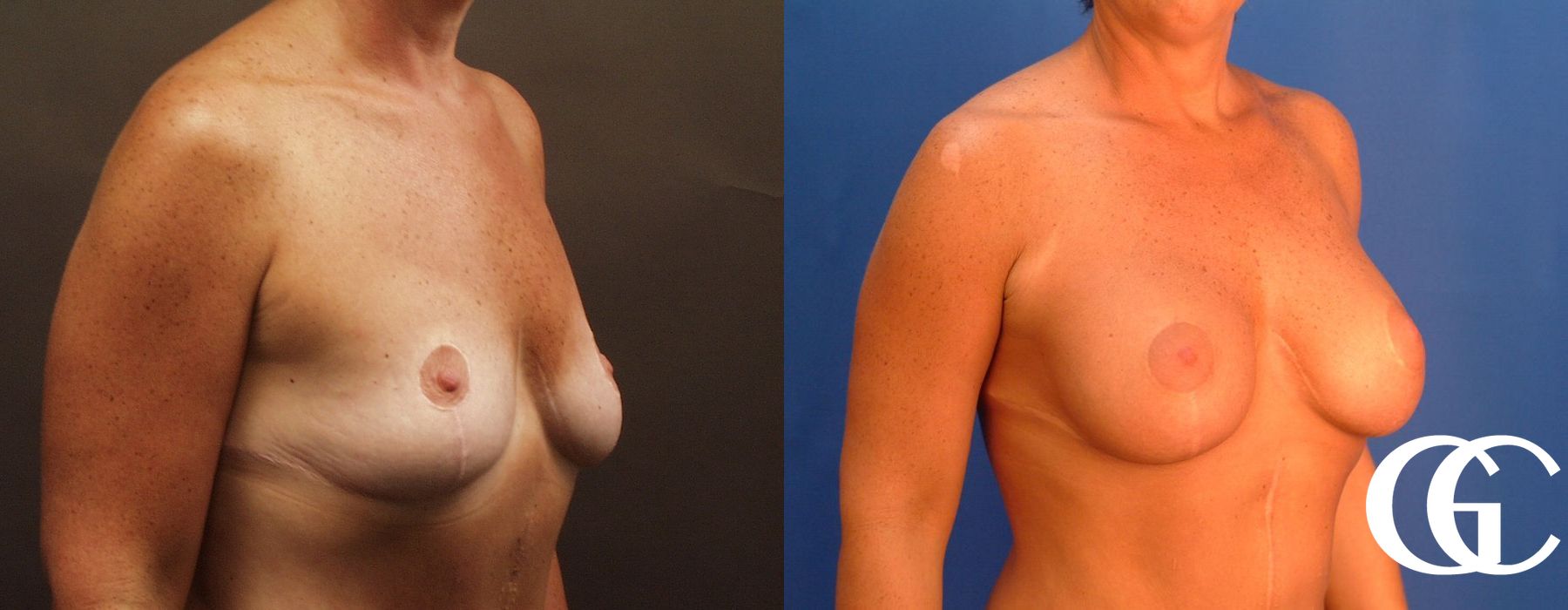 Breast Augmentation - Thumbnail 3