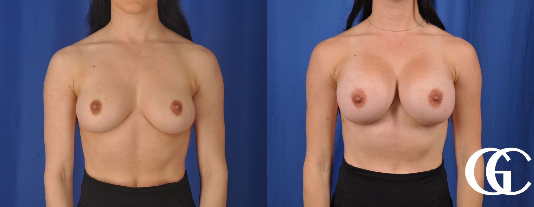 Breast Augmentation - Thumbnail 2