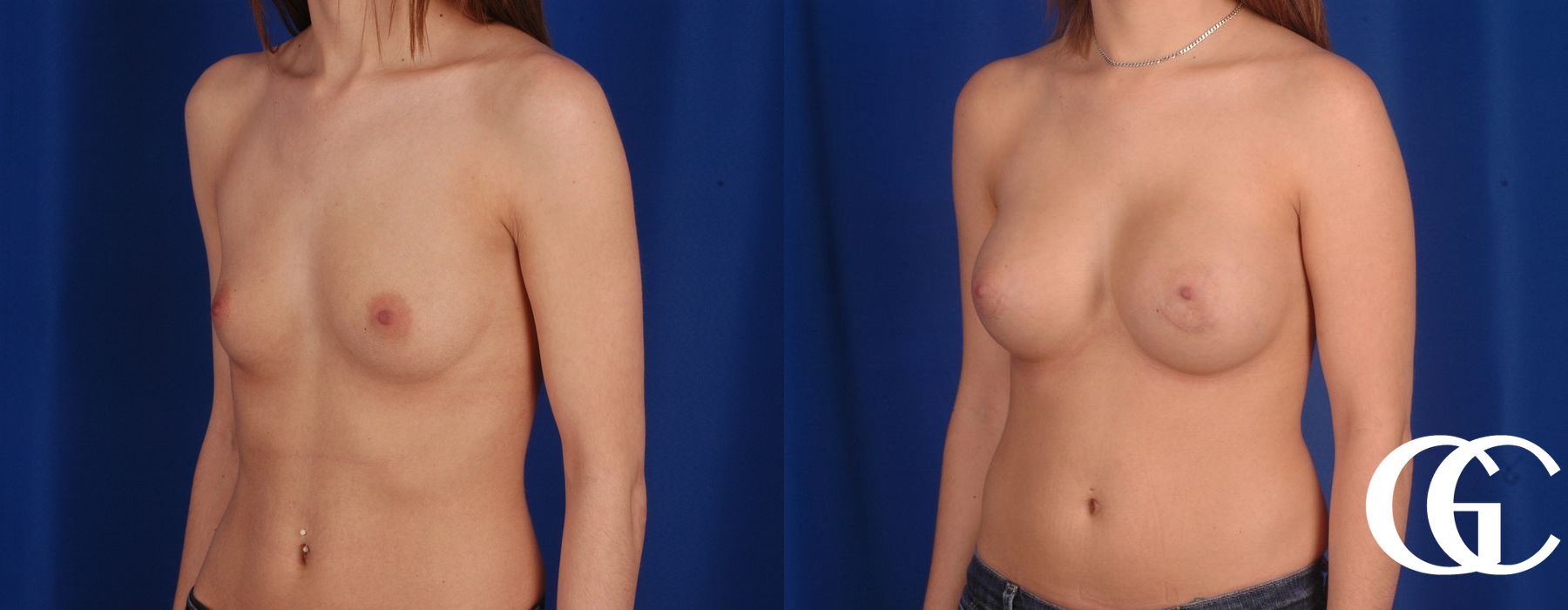 Breast Augmentation - Thumbnail 5