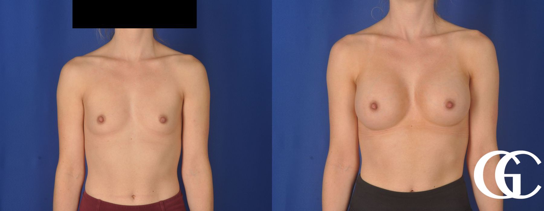 Breast Augmentation - Case 7222
