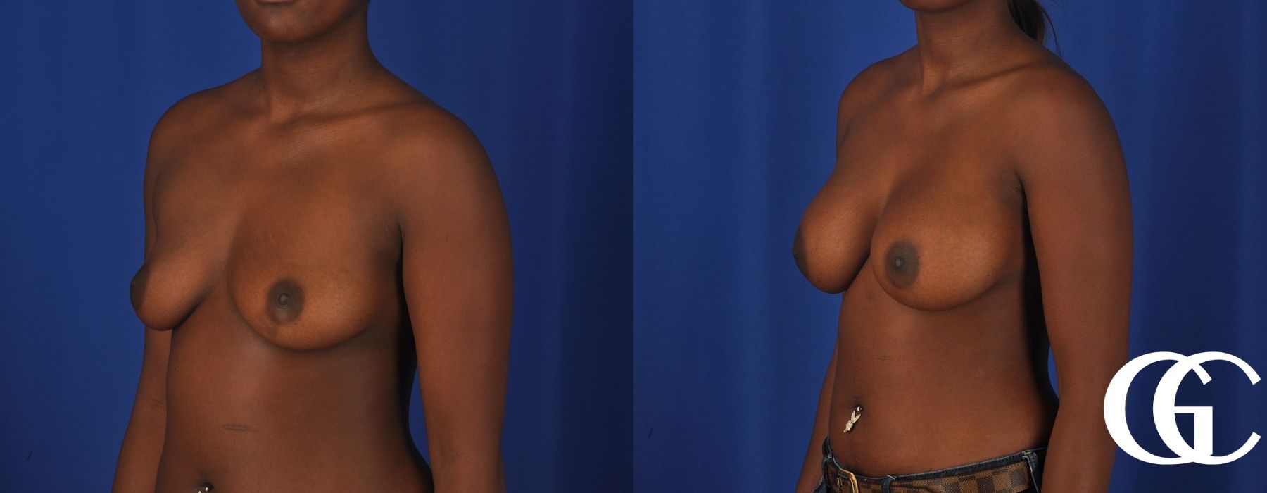 Breast Augmentation - Thumbnail 2