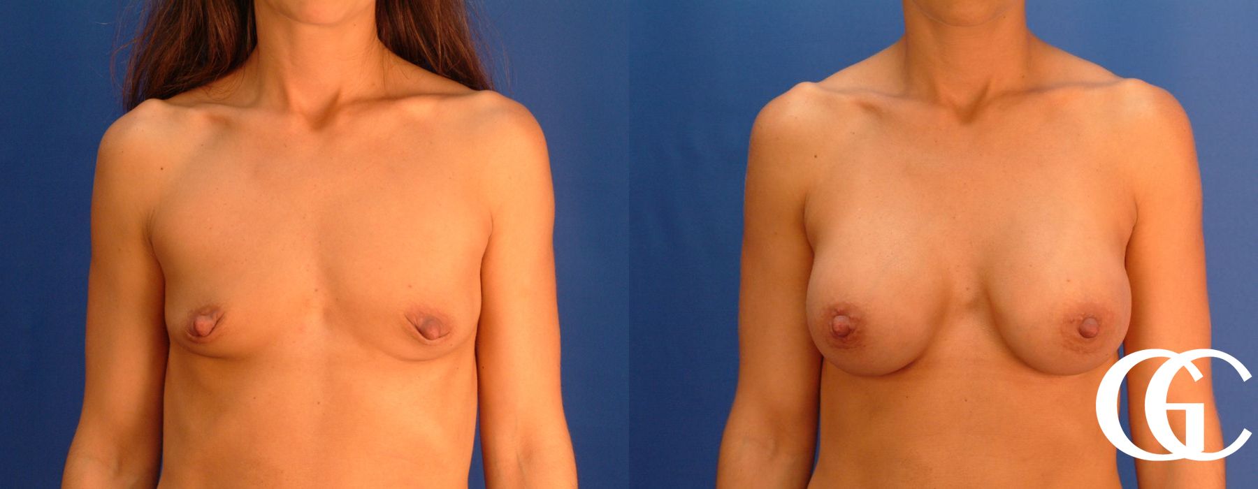 Breast Augmentation - Thumbnail 2