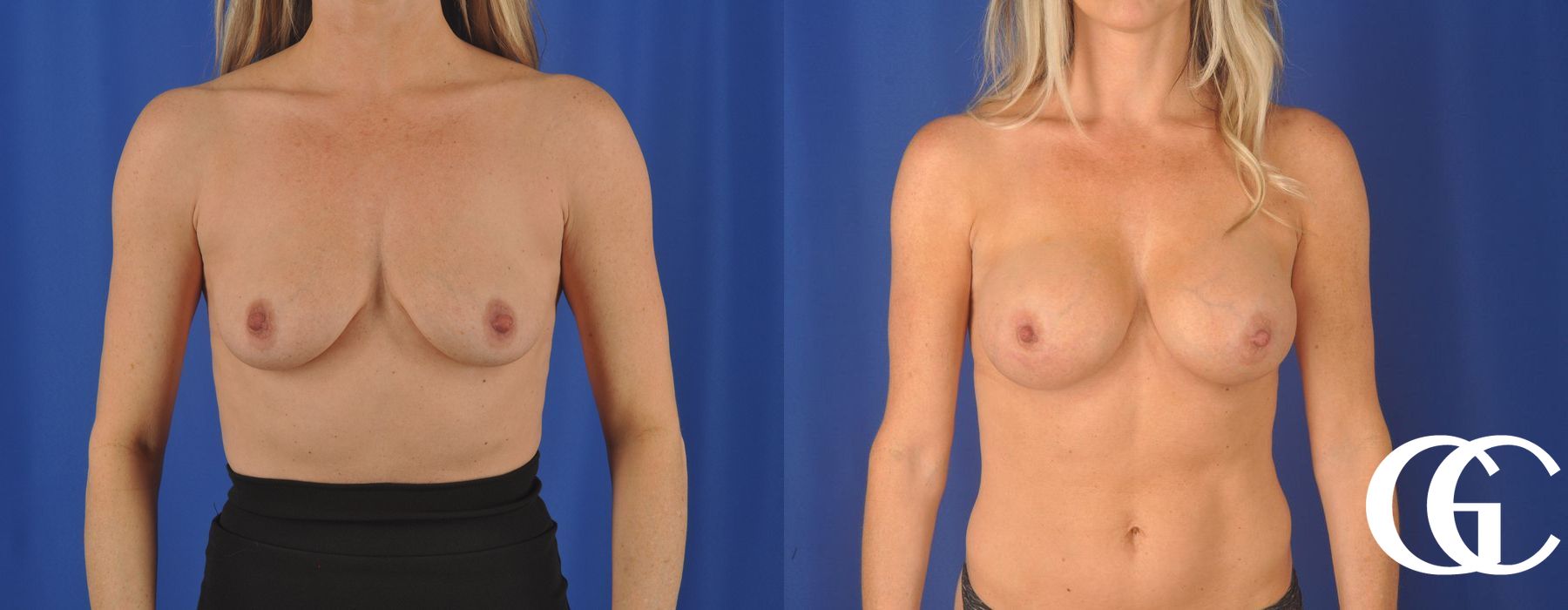 Breast Augmentation - Thumbnail 2