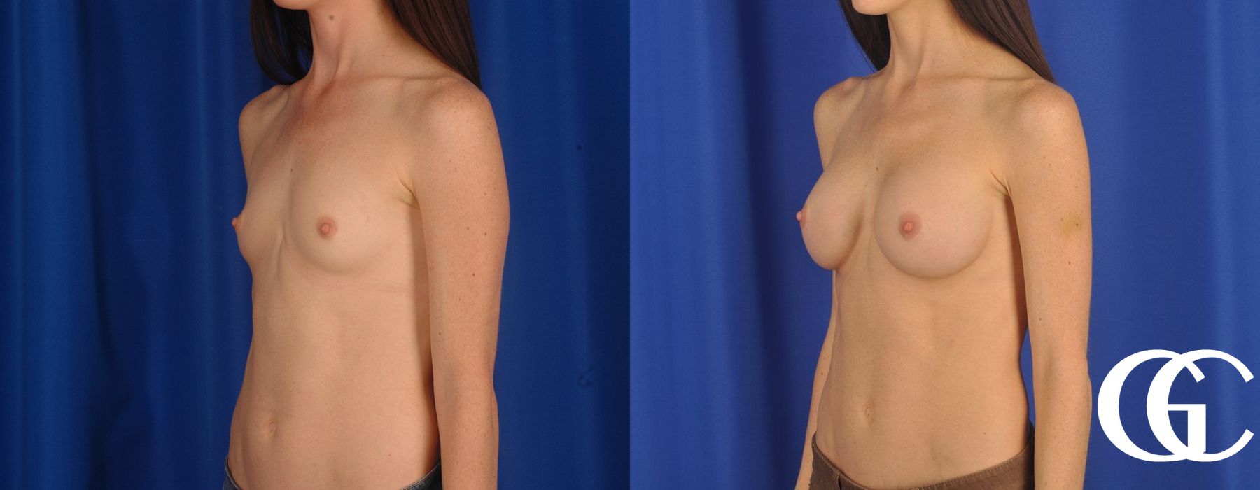 Breast Augmentation - Thumbnail 4