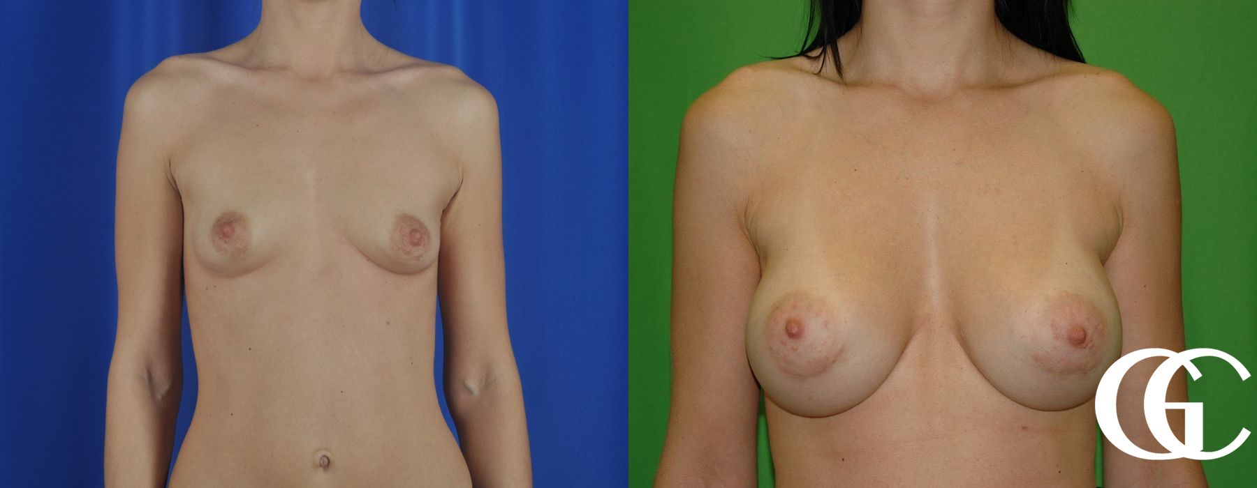 Breast Augmentation - Thumbnail 2