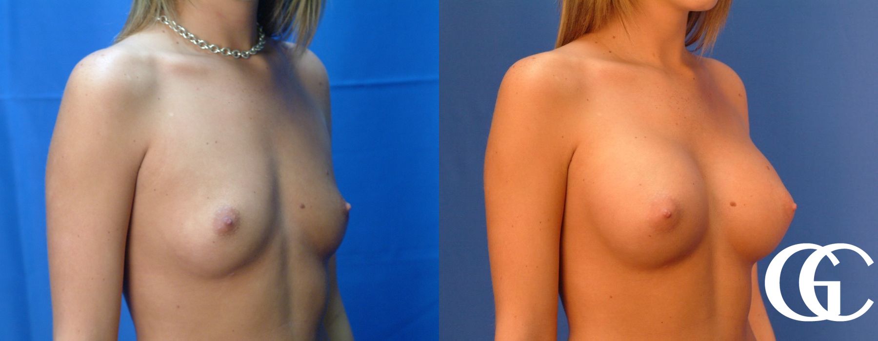 Breast Augmentation - Thumbnail 4