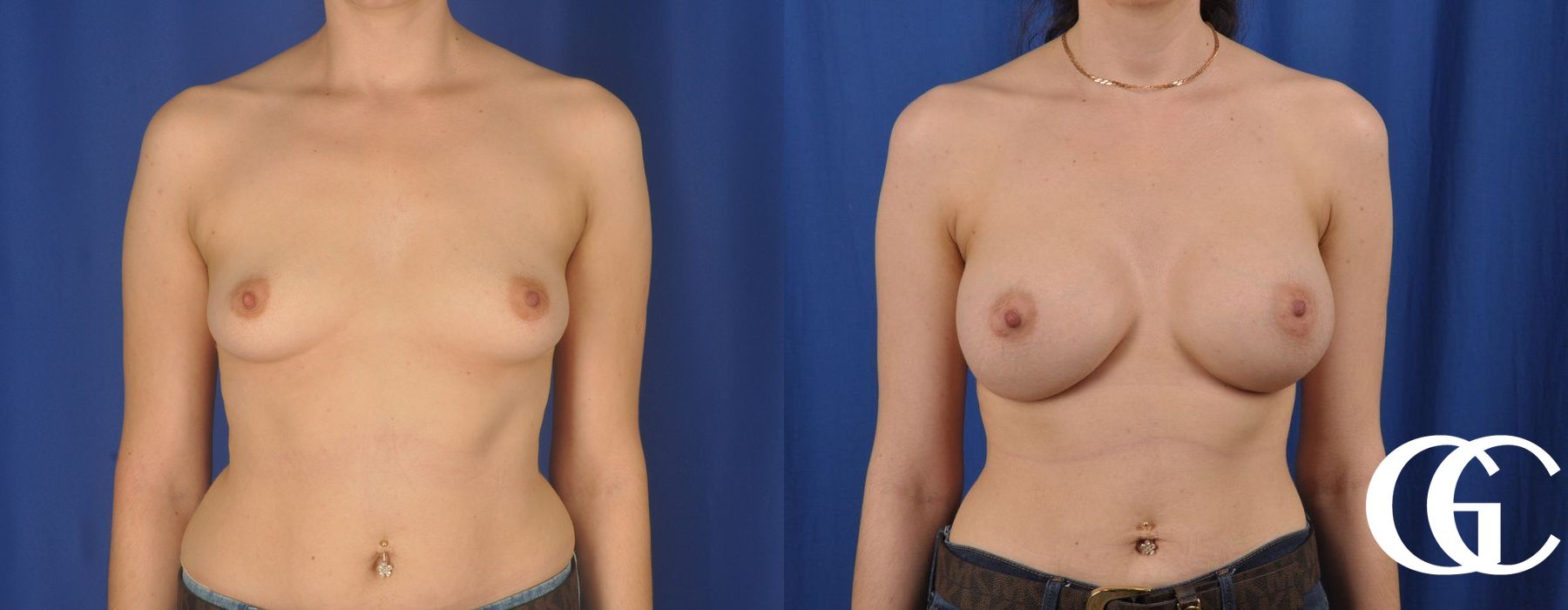 Breast Augmentation - Thumbnail 2