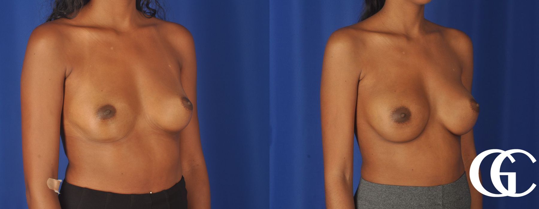 Breast Augmentation - Thumbnail 2
