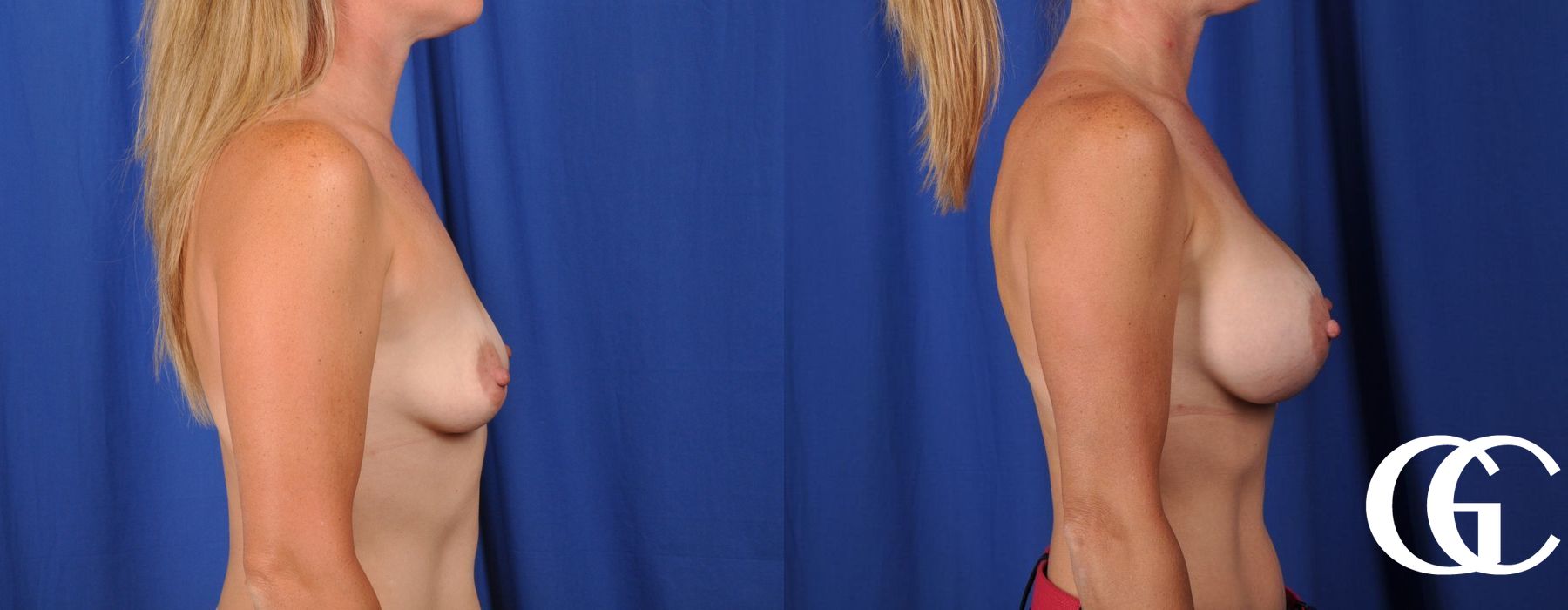 Breast Augmentation - Case 7145
