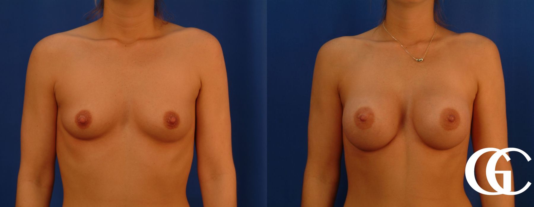 Breast Augmentation - Thumbnail 2