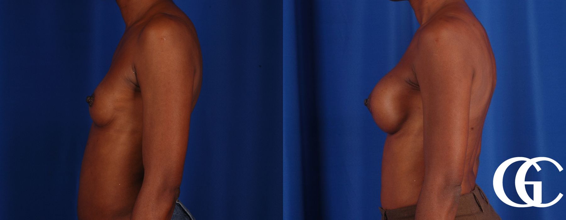 Breast Augmentation - Thumbnail 2