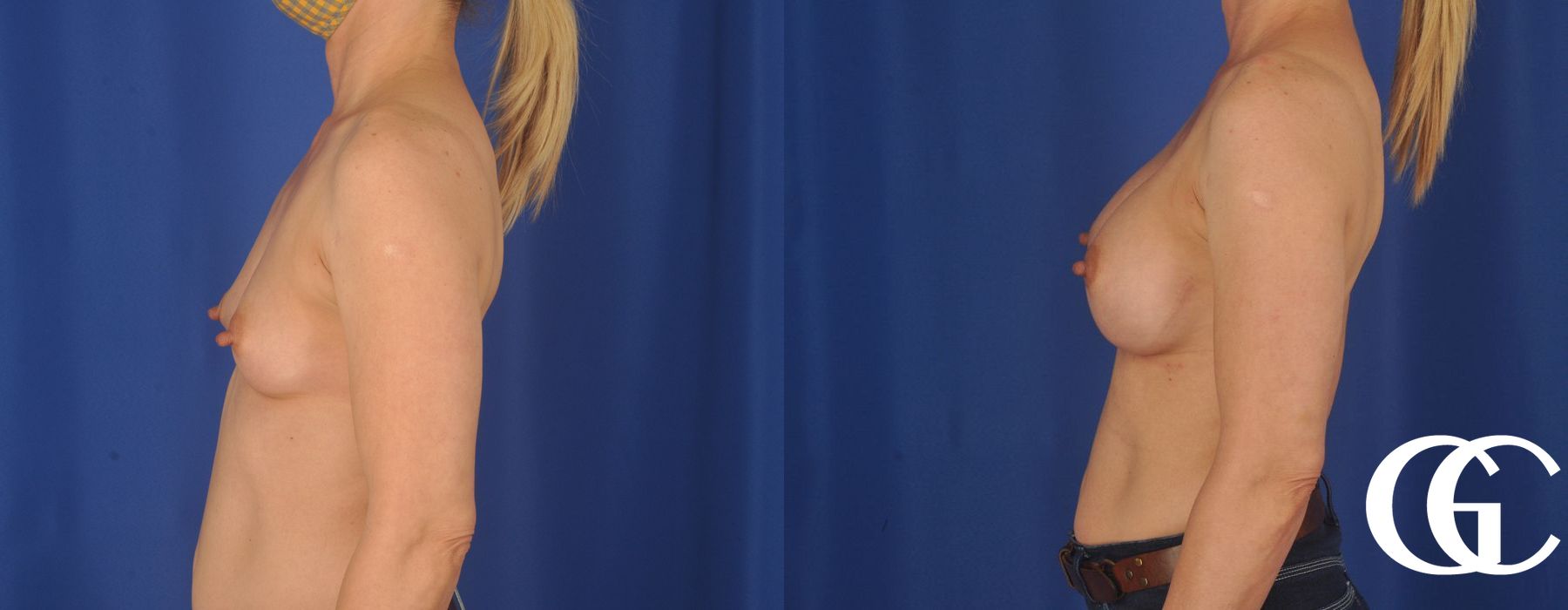 Breast Augmentation - Case 7223